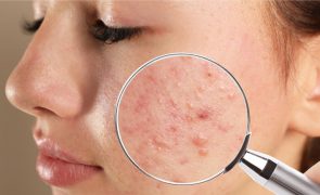 Seis dicas para acabar com a acne
