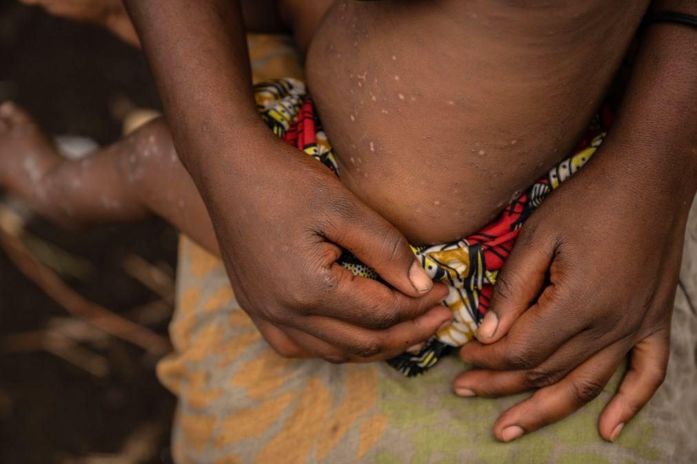 Portugal vai doar vacinas contra a mpox a países africanos