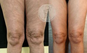 Lipedema - A doença que afecta quase 1 milhão de mulheres em Portugal!