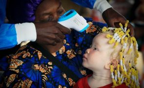Médicos angolanos levam conforto a centenas de albinos no Bié