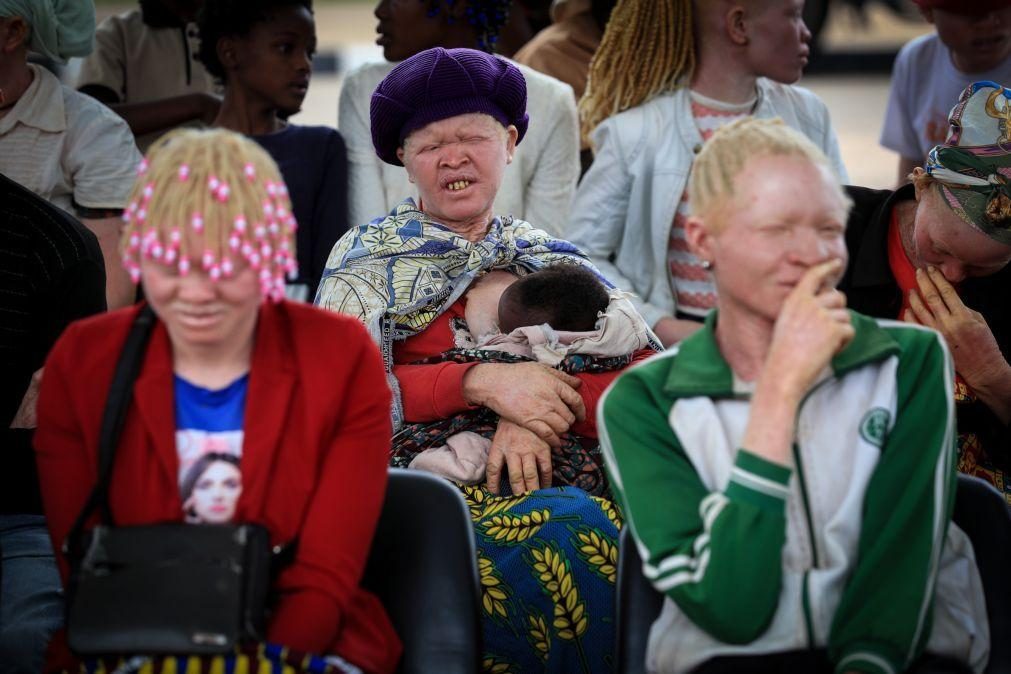 Cancro da pele continua a fazer vítimas entre albinos em Angola por falta de apoios - Associação